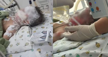 Bebê sofre queimaduras graves após acidente em Chapecó
